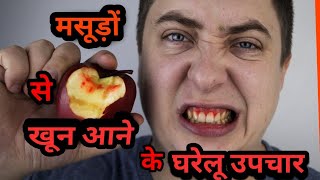 bleeding gums, causes, home remedies and treatment screenshot 5