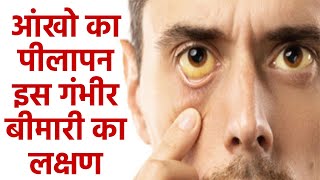 आंखो का पीलापन इस गंभीर बीमारी का लक्षण,Anemia से लेकर Kidney Failure तक का खतरा | Boldsky screenshot 4