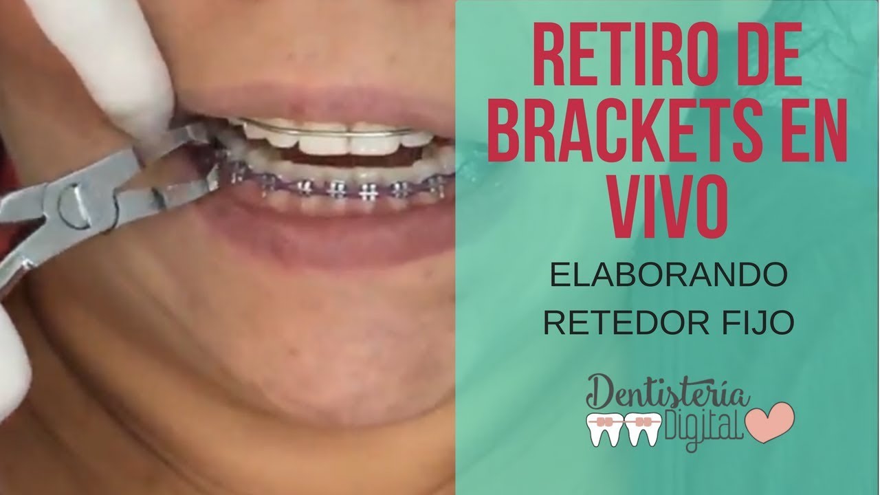 photo Aparato Para Despues De Los Brackets retiro de brackets y colocacion de retenedor fijo braces off and fixed retainer putting on