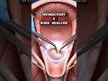 Myomectomy &amp; Womb Healing: What Really Happens After Fibroid Surgery #shorts #myomectomy