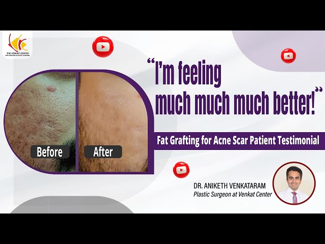 Acne Scars Treatment Patient Review | Fat Grafting for Deep Acne Scars | Venkat Center