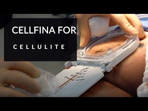 Video: Spring na walang cellulite