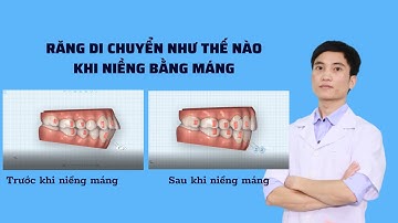 Răng Di Chuyển Như Thế Nào Khi Niềng Răng Máng Trong Suốt Invisalign