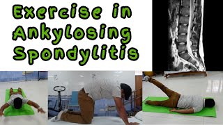 Exercise in ankylosing Spondylitis, exercise in bamboo spine