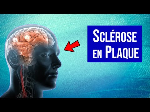 Vidéo: Sclérose en plaques pédiatrique : symptômes, traitement et pronostic