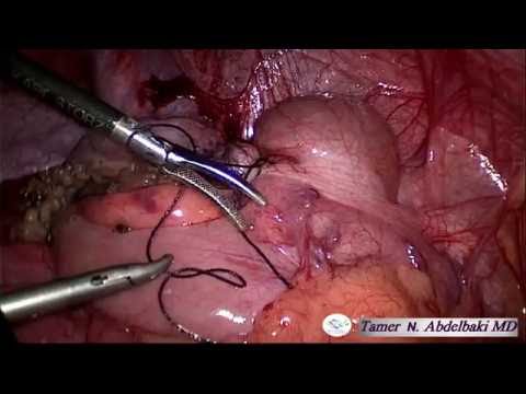 Laparoscopic Appendectomy High Definition - إستئصال الزائدة الدودية بالمنظار، د تامر نبيل عبدالباقي