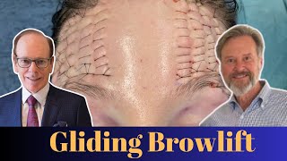 A NEW Plastic Surgery Approach | The Gliding Browlift