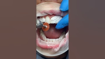 Composite Edge Bonding #shorts