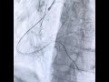 Case 21 Angioplasty Of Diffusely Diseased RCA 