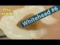 #6 Squeezing Whiteheads Close up