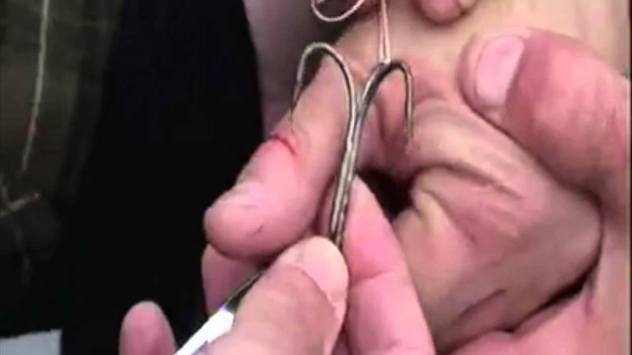Fish Hook Removal - Pass The Whiskey!