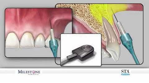 Supraperiosteal Injection