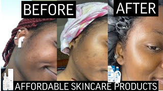 HOW I CLEARED MY ACNE USING THE ORDINARY and CERAVE Products |#skincare