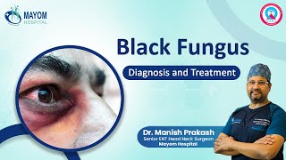 Black Fungus - Diagnosis and Treatment by Dr Manish Prakash Mayom Hospital Gurugram NCR India