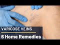 6 Home Remedies For Varicose Veins