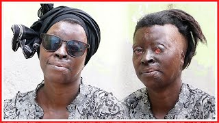 HATIMAYE MAMA ALIYEANGUKA KWENYE KARAI LA MAFUTA APATA MATIBABU, AMWAGA MACHOZI AKIELEZA ANAYOPITIA! screenshot 5