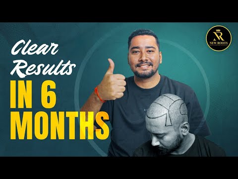 First PRP After Hair Transplant 😃 | 5 Months Hair Result | New Roots Kolkata