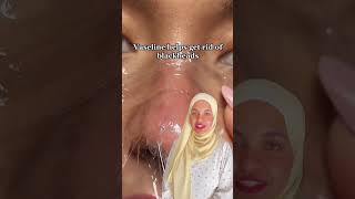 الفازلين للتخلص من الرؤوس السودا skin skincare beauty