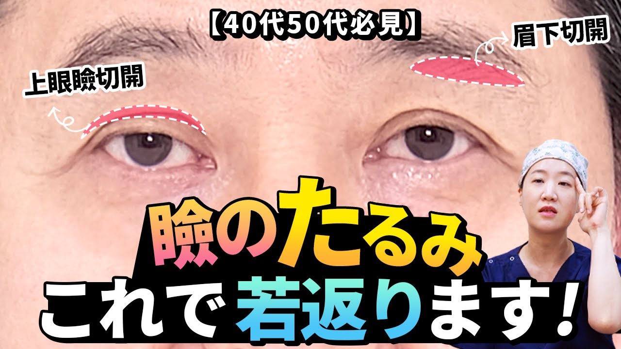 #上眼瞼手術 #眉下リフト #瞼のたるみ 