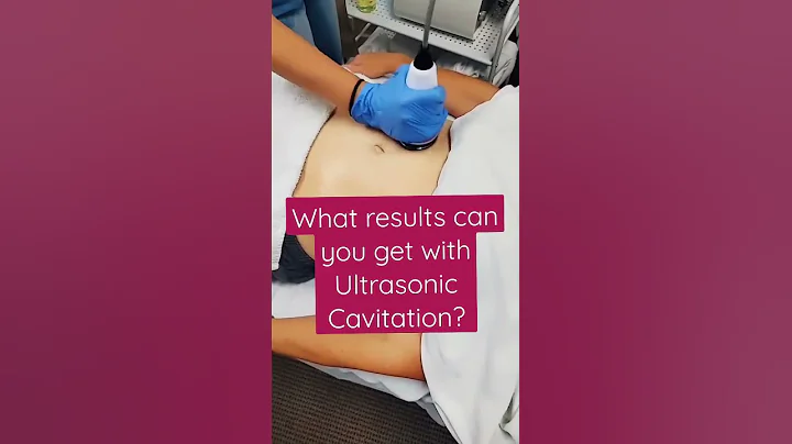 Ultrasonic Cavitation - Before and After - Murrieta, CA