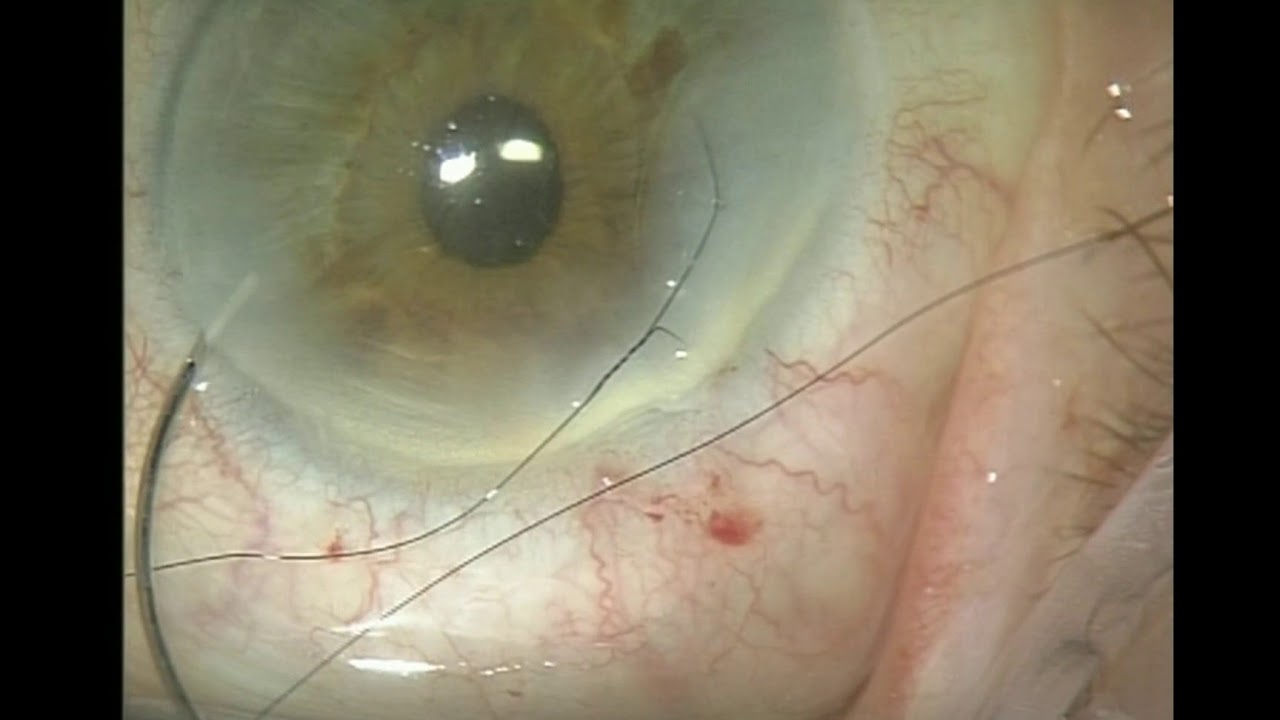 Corneal burn Suture Technique YouTube