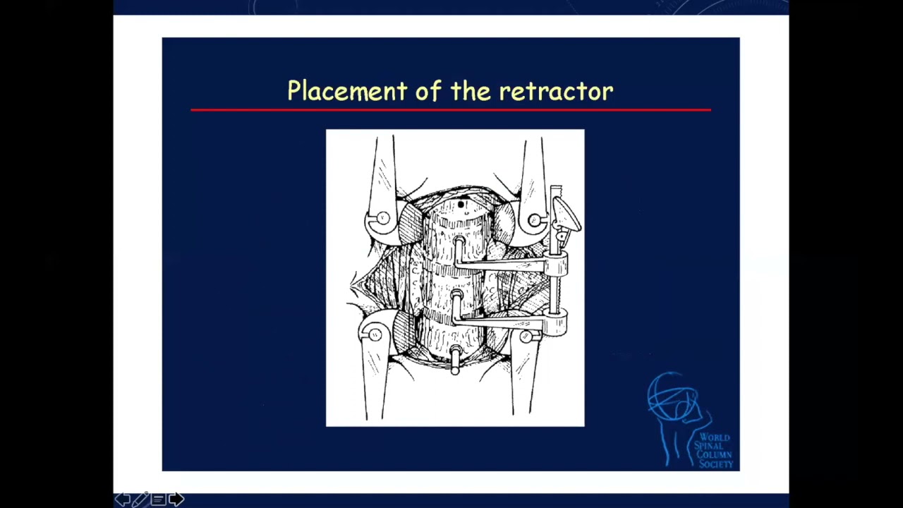 Tricks for Anterior Cervical Disc Surgery