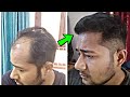 Case Study : 6 Months Of Hair Transplant Surgery Video || Best FUE Hair Transplant Result In India