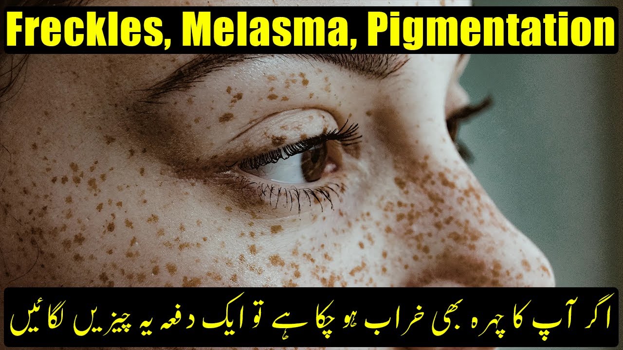 Freckles Melasma Pigmentation Ko Khatam Karen Urdu Beauty Facts freckles-melasma-pigmentation-ko-khatam-karen-urdu-beauty-facts