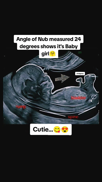 it's baby girl angle of nub measured 24 degrees🤗|#pregnancy #baby