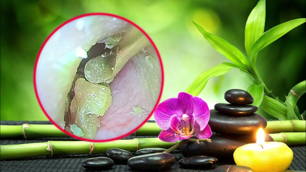 How to earwax removal ear wax extractions YouTube