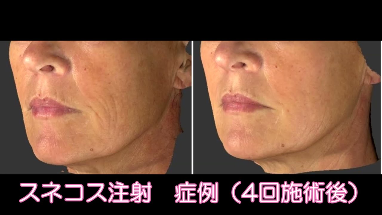 スネコス注射 Snekos