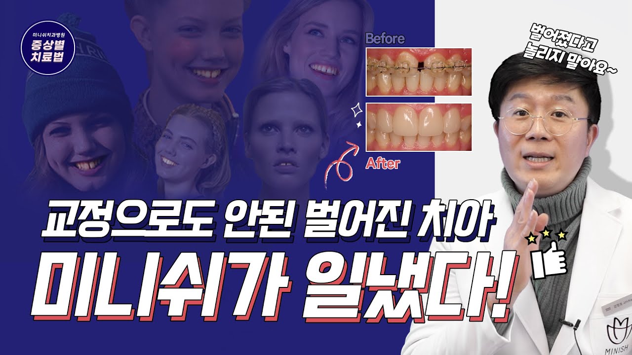 교정으로도 벌어진치아 해결되지 않는다면?ㅣ미니쉬ㅣ