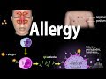 Allergy  mechanism symptoms risk factors diagnosis treatment and prevention animation