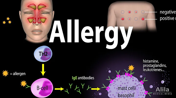 Allergy - Mechanism, Symptoms, Risk factors, Diagnosis, Treatment and Prevention, Animation - DayDayNews