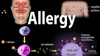 Allergy - Mechanism, Symptoms, Risk factors, Diagnosis, Treatment and Prevention, Animation Resimi