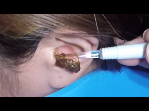 une oreille bouché 