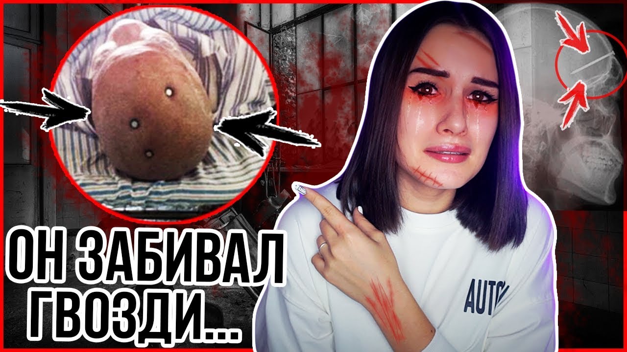 ЗАБИВАЛ ГВОЗДИ СЕБЕ В ГОЛОВУ! БОЛЬНОЙ ПАЦИЕНТ! УЖАСНАЯ ИСТОРИЯ! - YouTube