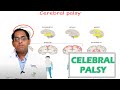 Cerebral palsy | DR Srinath | Health And Beauty