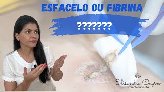 ESFACELO OU FIBRINA? VOCÊ TEM OU CONHECE ALGUÉM COM UMA FERIDA?