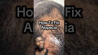 How To Fix Alopecia Blossomcosmetics