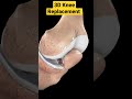 3d knee replacement animation kneereplacementoperation 3danimation 3d kneearthritis kneepain