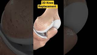 3D Knee Replacement Animation✓✓• #kneereplacementoperation #3danimation #3d #kneearthritis #kneepain screenshot 1