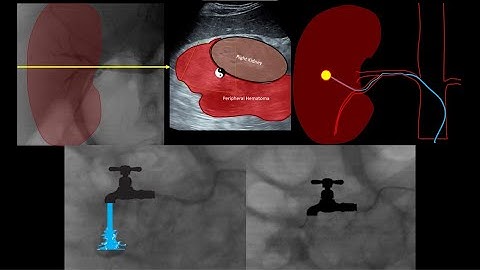 Renal Interventions - Embolisation Case 6: Coiling of Traumatic Renal Artery Pseudoaneurysm
