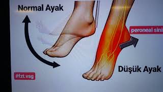 Peroneal Sinir Tuzak Nöropatisi