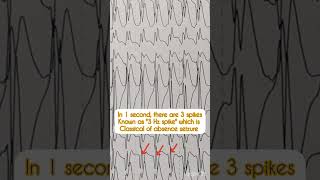 Classical 3-Hz spike EEG discharges in Absence seizures! #mbbs #medicine #neurology