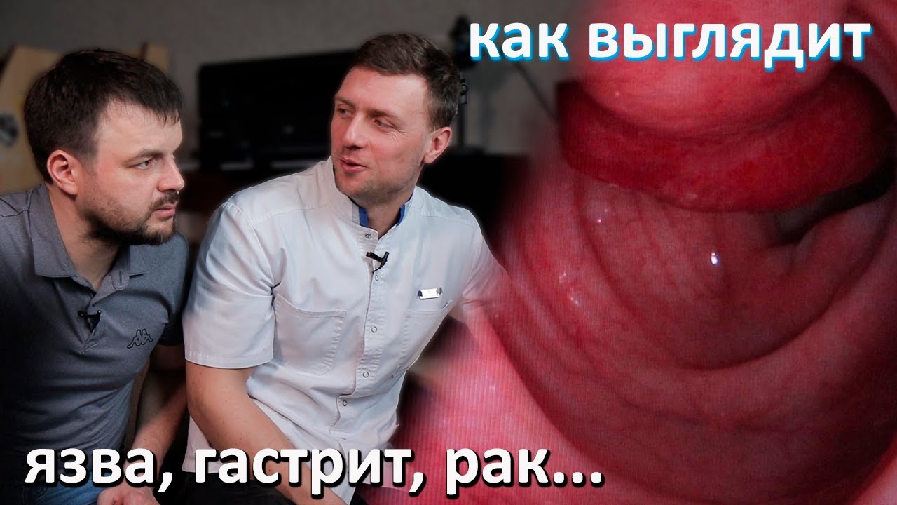 Как реально выглядит рак, эрозия, язва и другие заболевания ЖКТ. Разбор снимков с гастроскопии
