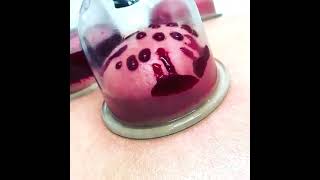 how cupping therapy work's || short video for better understand screenshot 5