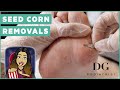 Seed corn removals on feet: a Celine Dion fan!