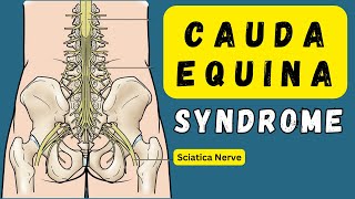 Cauda Equina Syndrome - Red flags symptoms you must know