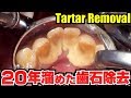 20年溜めた歯石除去😀Tartar Removal 牙石去除[プロの歯石取り]